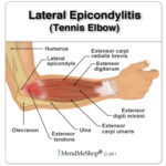 Ask the Doc: Elbow Pain By Dr. Vince DiSaia